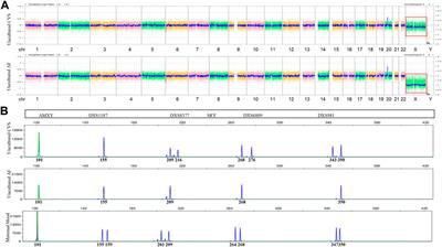 Case report: Prenatal diagnosis of rare chromosome mosaicism: discordant results between chorionic villi and amniotic fluid samples